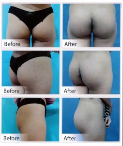 Buttock Augmentation - Naravee Aesthetic Clinic